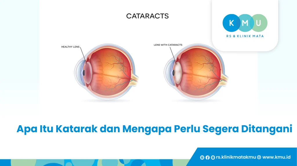Apa Itu Katarak dan Mengapa Perlu Segera Ditangani - Operasi Katarak Madura