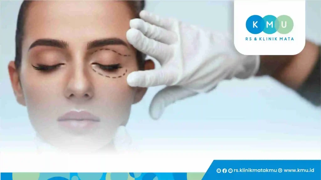 Apa Itu Blepharoplasty?