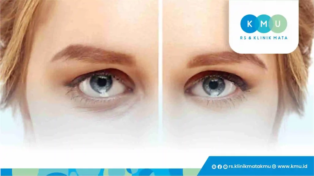 Manfaat Blepharoplasty untuk Kecantikan dan Kesehatan