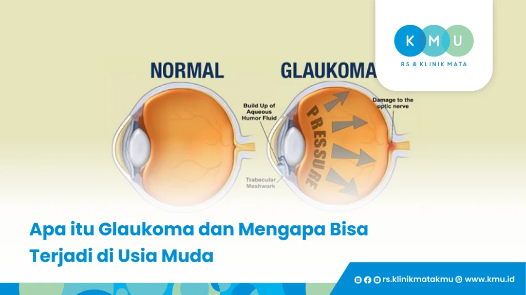 Apa Itu Glaukoma - Glaukoma di Usia Muda