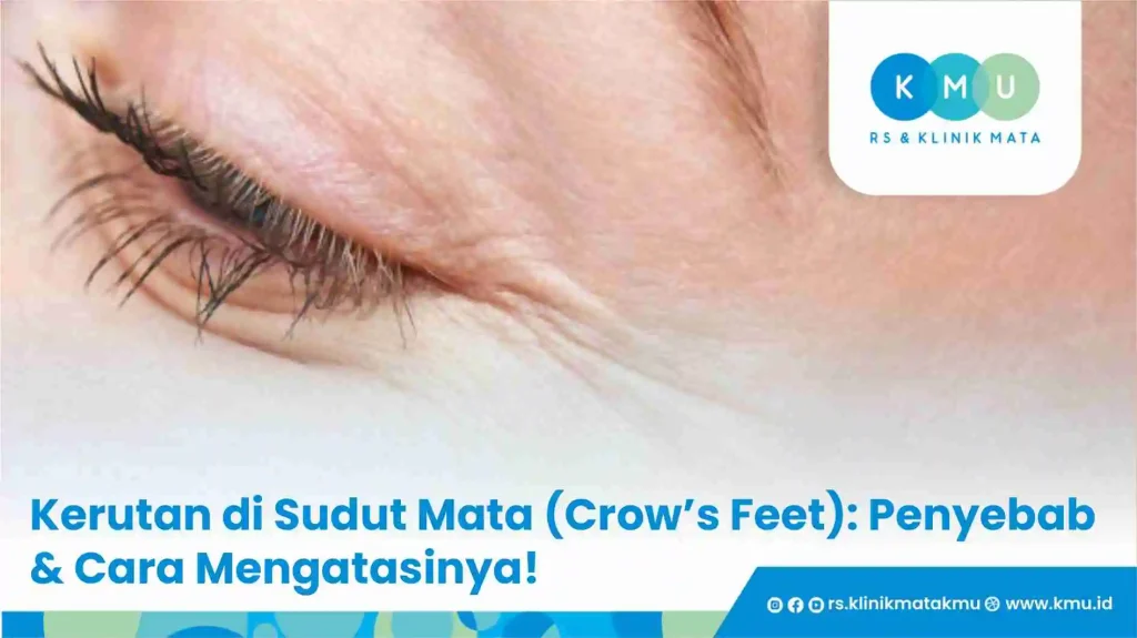 Kerutan di Sudut Mata (Crow’s Feet): Penyebab & Cara Mengatasinya!