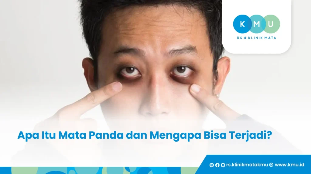 Apa Itu Mata Panda dan Mengapa Bisa Terjadi - cara mengatasi mata panda