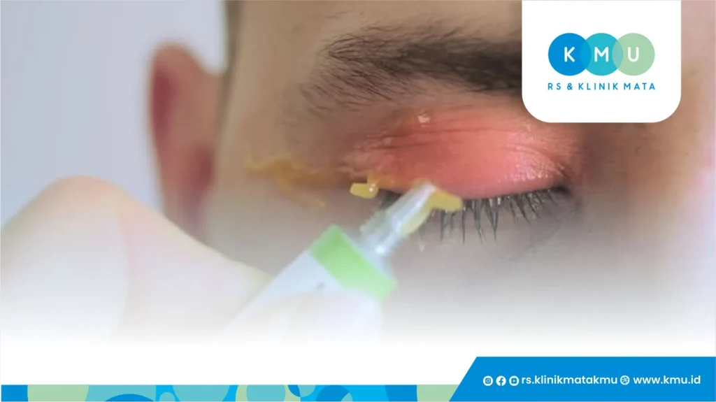 Pengobatan Herpes Mata