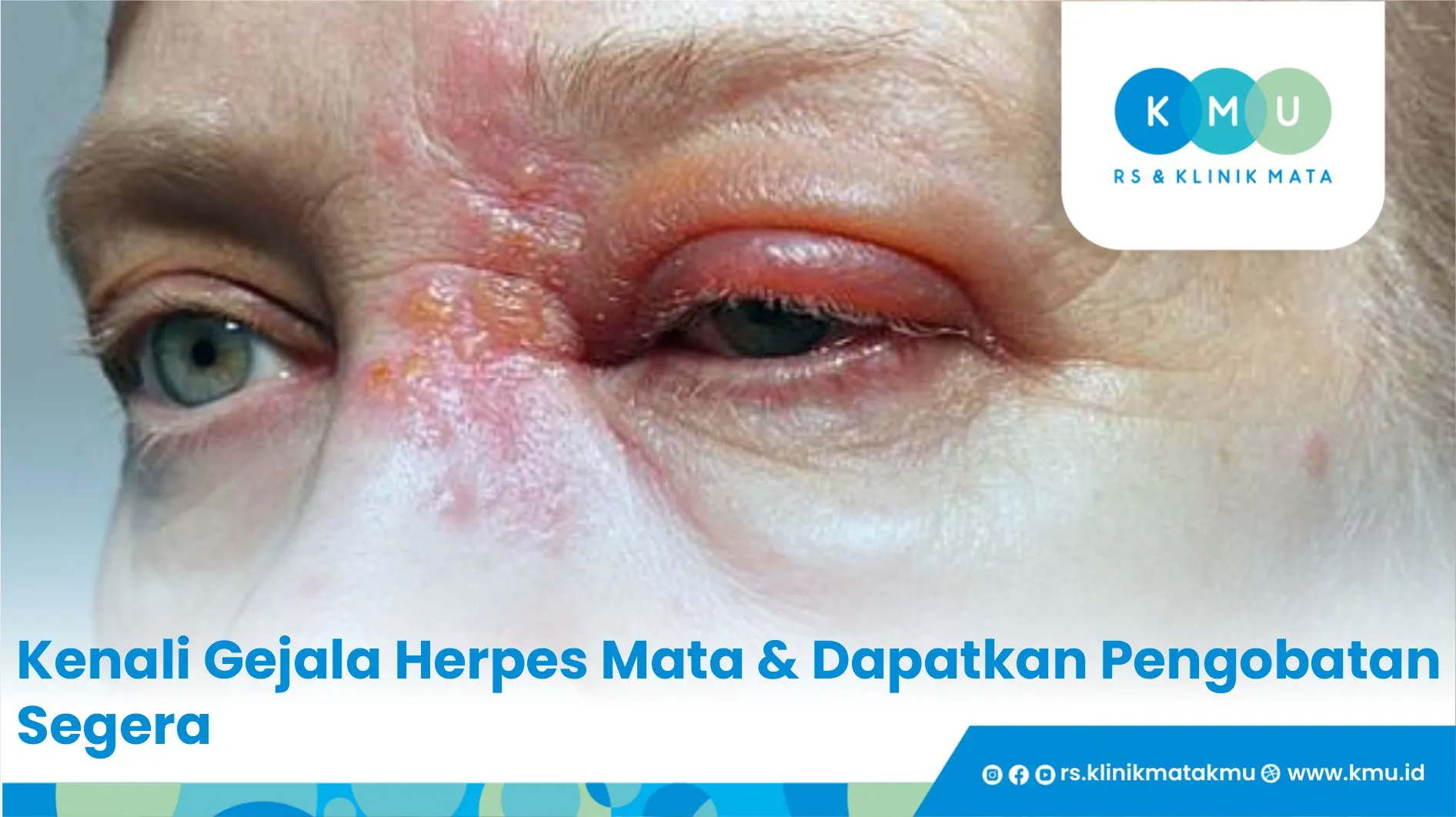 Kenali Gejala Herpes Mata & Dapatkan Pengobatan Segera