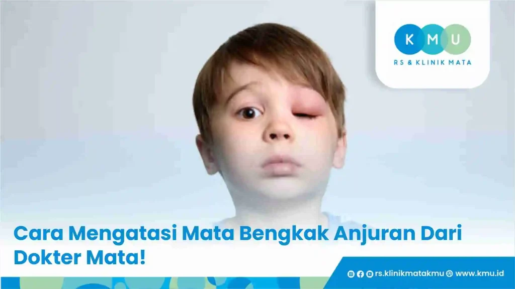 Cara Mengatasi Mata Bengkak Anjuran Dari Dokter Mata! 
