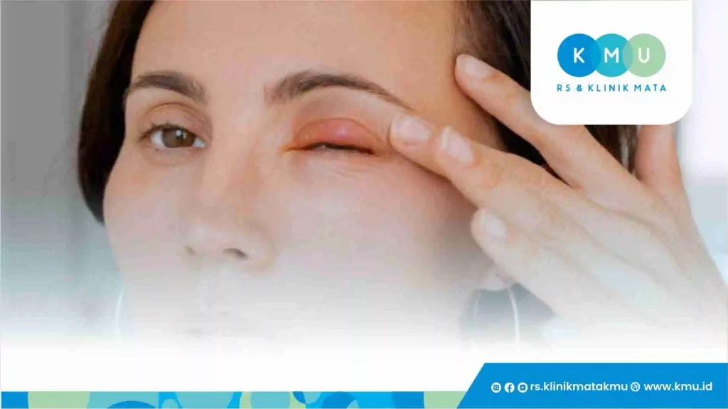 Cara Mengatasi Mata Bengkak Sesuai Anjuran Dokter Mata