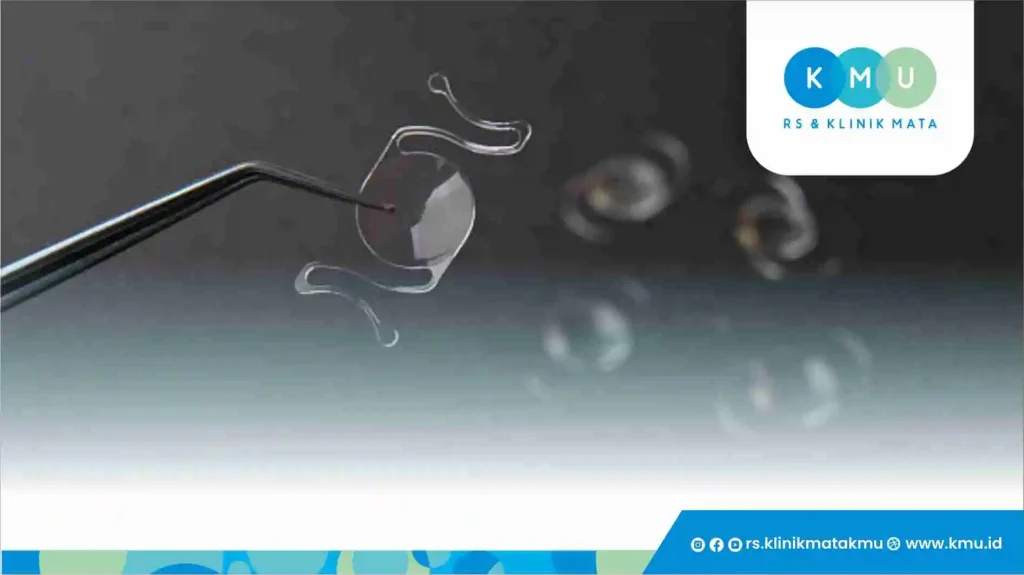 Apa Itu Refractive Lens Exchange (RLE) atau Tanam Lensa?Â