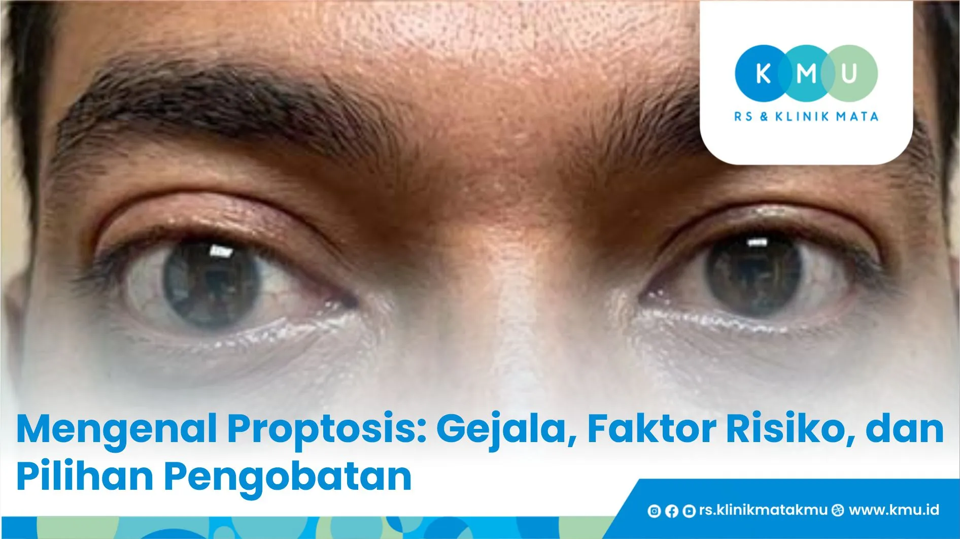 Mengenal Proptosis: Gejala, Faktor Risiko, dan Pilihan Pengobatan