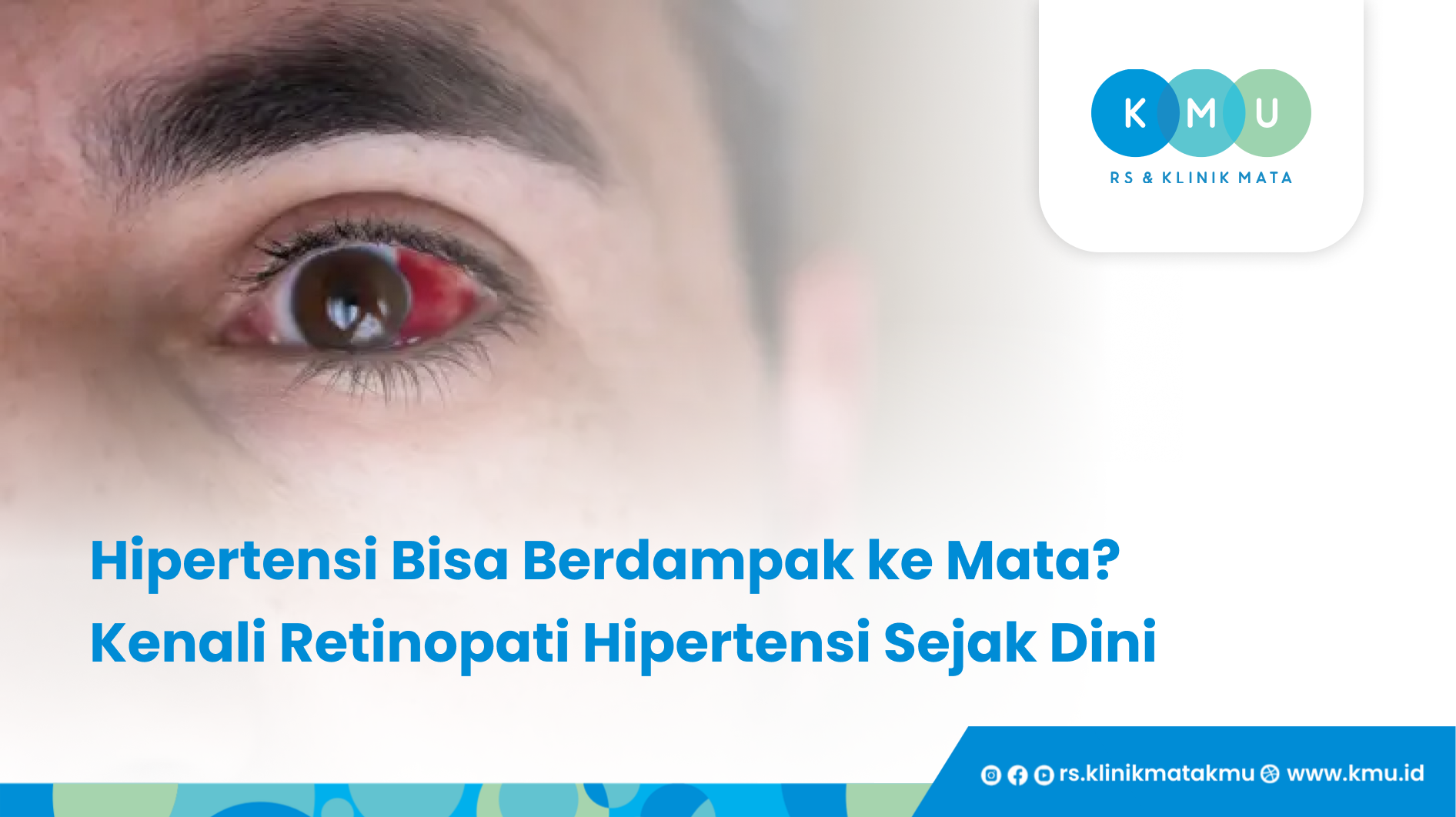 Hipertensi Bisa Berdampak ke Mata_ Kenali Retinopati Hipertensi Sejak Dini