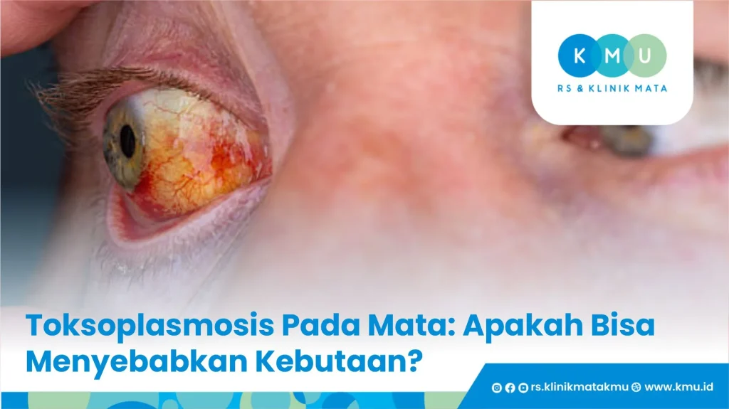 Toksoplasmosis Pada Mata: Apakah Bisa Menyebabkan Kebutaan?
