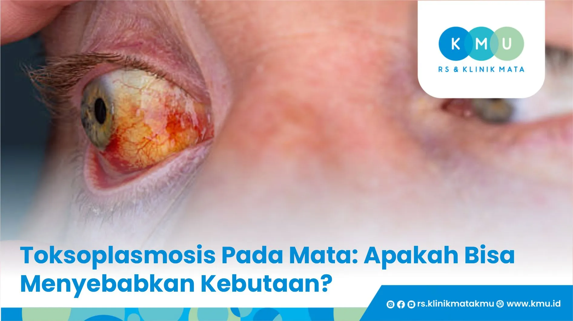 Toksoplasmosis Pada Mata: Apakah Bisa Menyebabkan Kebutaan?