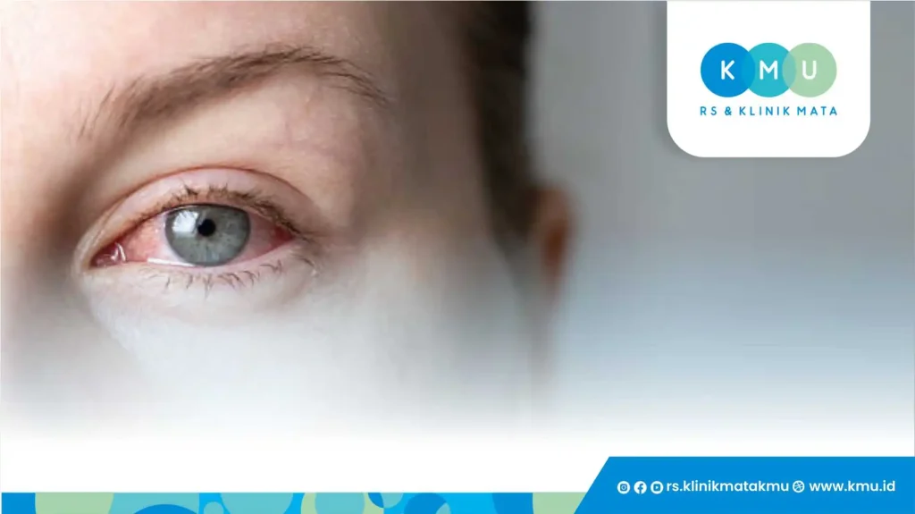 Apa Itu Konjungtivitis Bakteri?