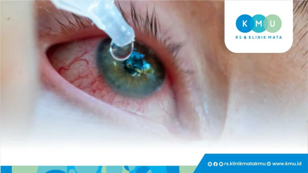 Cara Mengatasi Konjungtivitis Bakteri