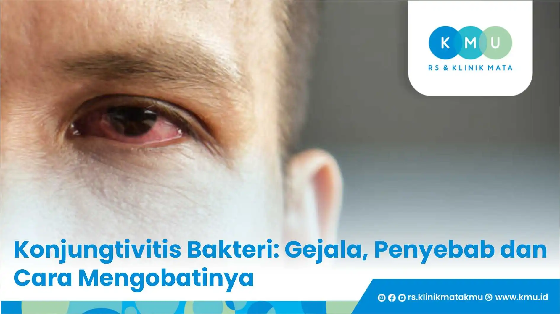 Konjungtivitis Bakteri: Gejala, Penyebab dan Cara Mengobatinya