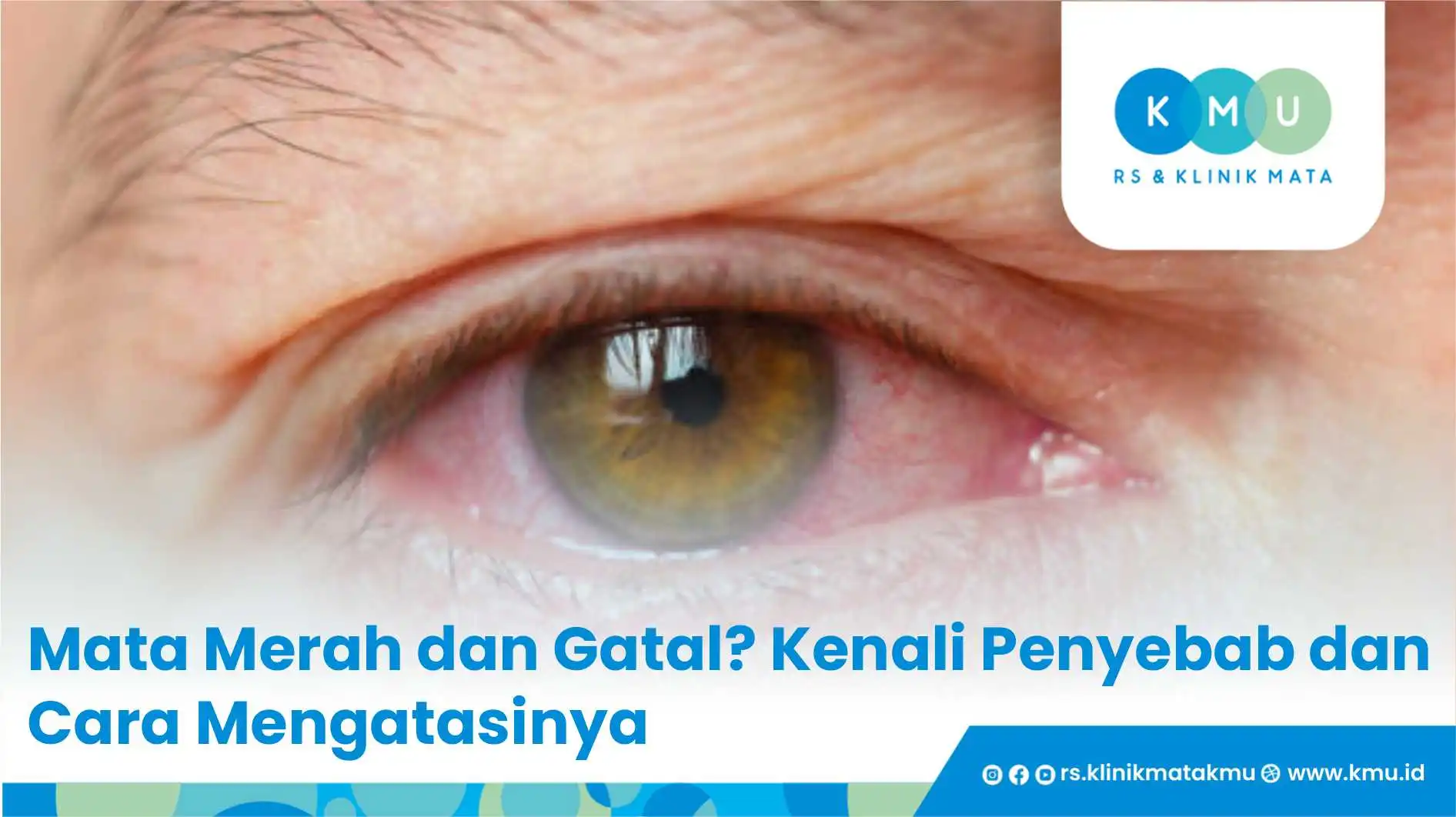 Mata Merah dan Gatal? Kenali Penyebab dan Cara Mengatasinya