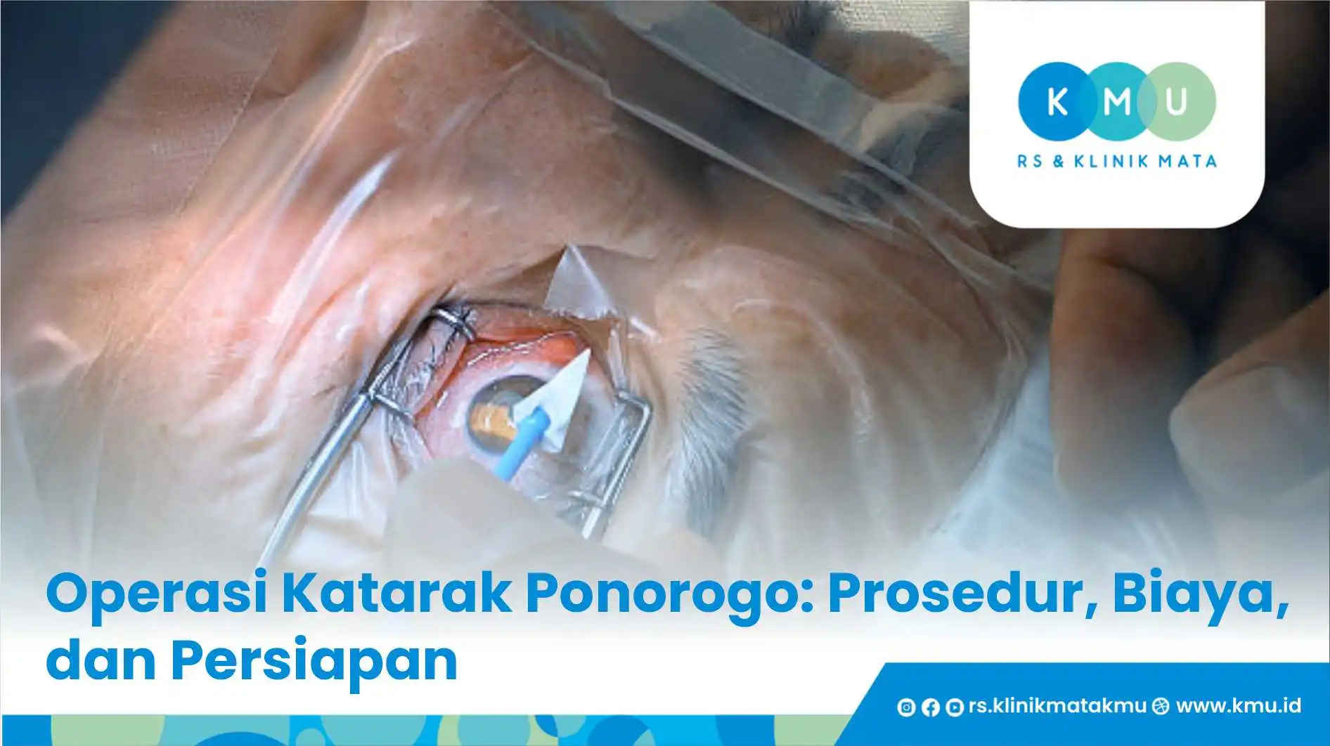 Operasi Katarak Ponorogo: Prosedur, Biaya, dan Persiapan