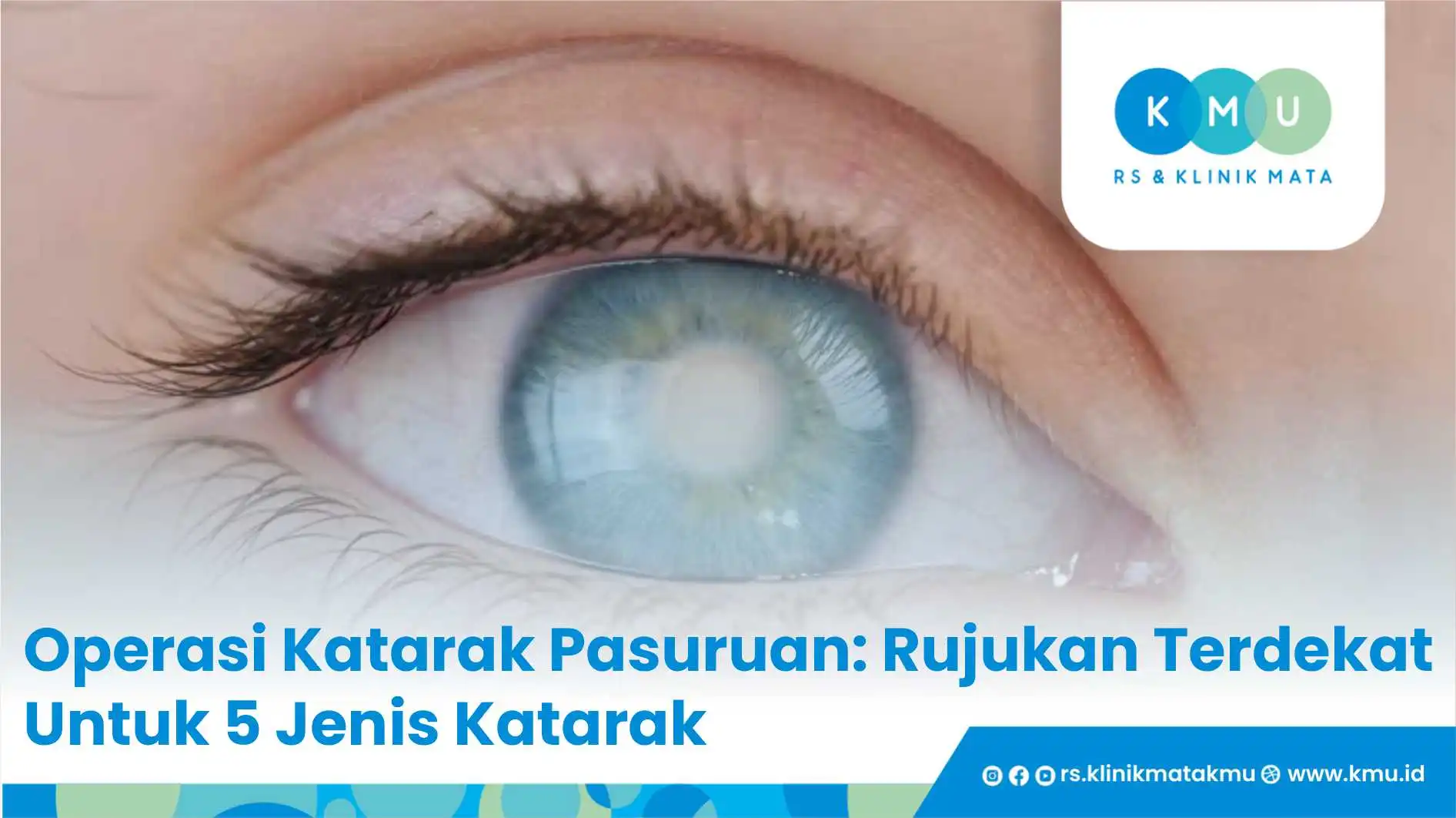 Operasi Katarak Pasuruan: Rujukan Terdekat Untuk 5 Jenis Katarak